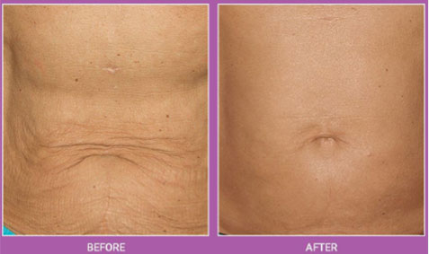 Thermage Cleveland | Skin Tightening Willoughby